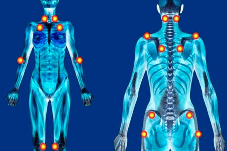 Nova Lei Reconhece Fibromialgia como Deficiência em Todo Brasil